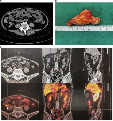 Appendiceal Neuroendocrine Tumor Is a Rare Cause of Ectopic Adrenocorticotropic Hormone Syndrome With Cyclic Hypercortisolism: A Case Report and Literature Review